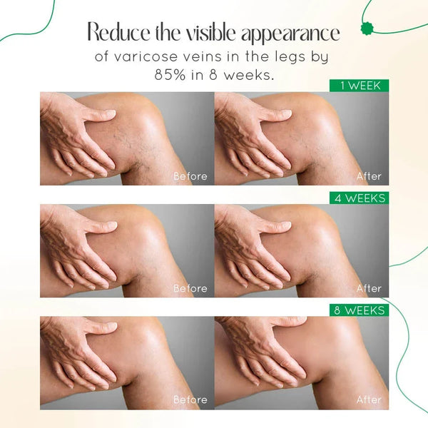 ODALIT Vein Therapy Cream