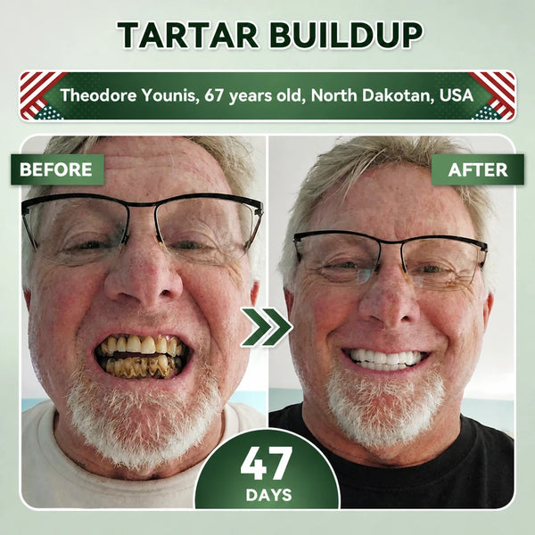 SmileRenew Dental Repair Strips