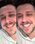InstaSmile Pro Cosmetic Veneers