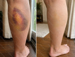 Bruiseshield Skin Strengthening Cream