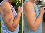 Bruiseshield Skin Strengthening Cream