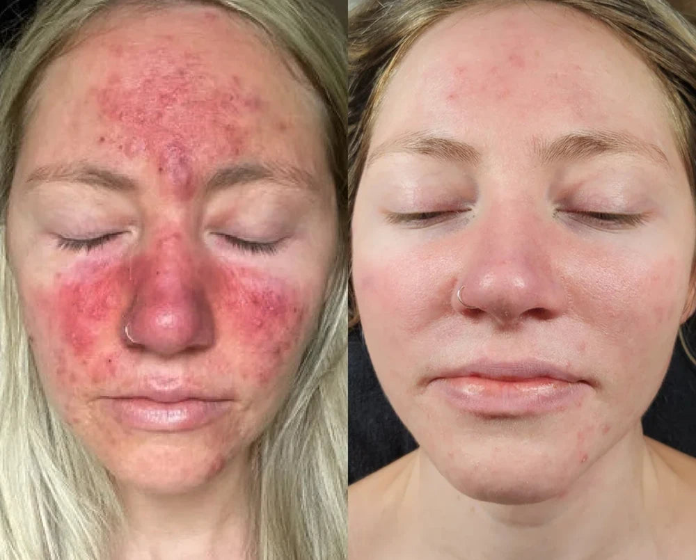 Biancat PsoriaMucin Relief Mist