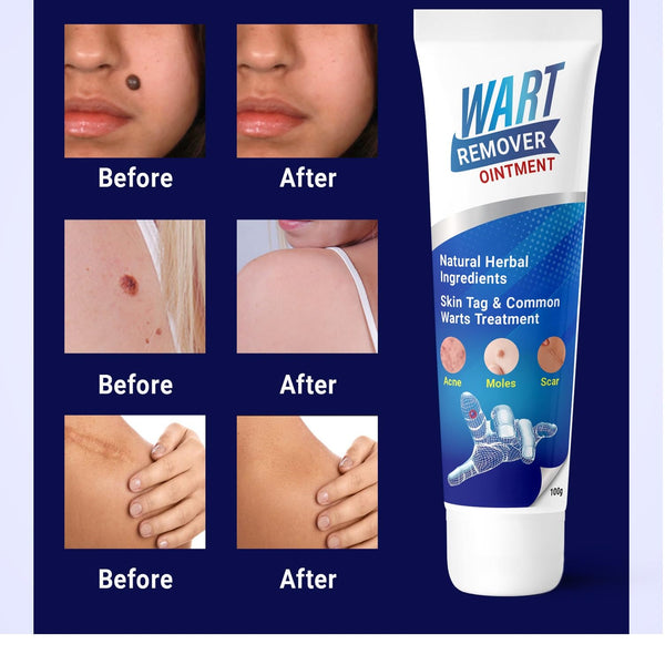 Mole & Wart remover ointment