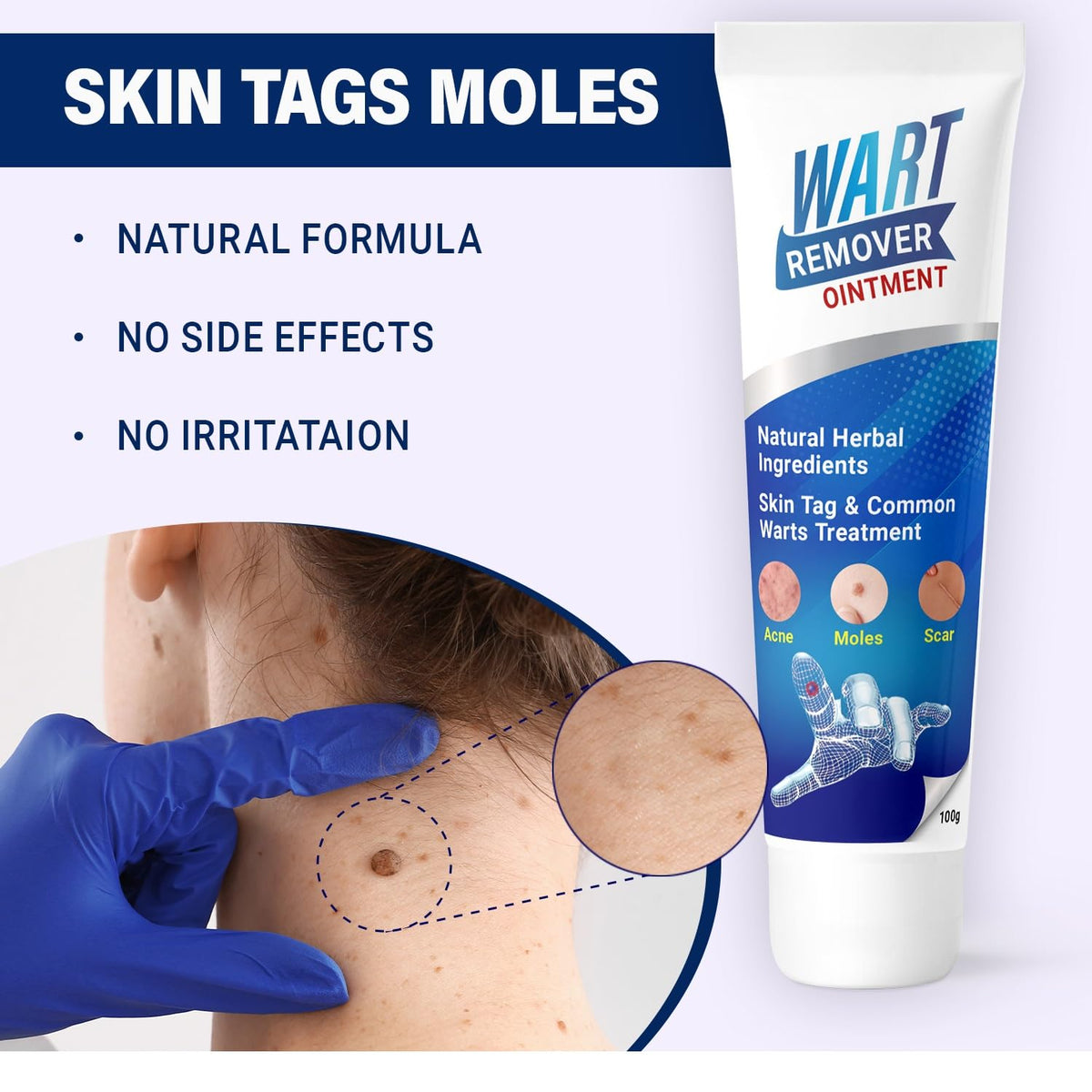 Mole & Wart remover ointment