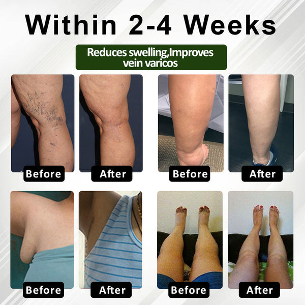 FluidEase Leg Therapy Cream