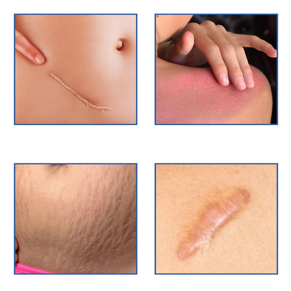 Scar Repair Gel