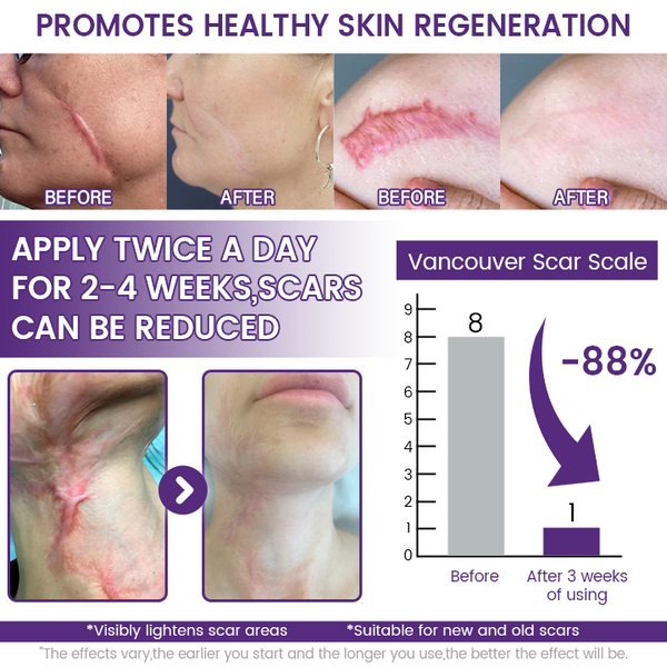 ReGenScar Advanced Scar Gel