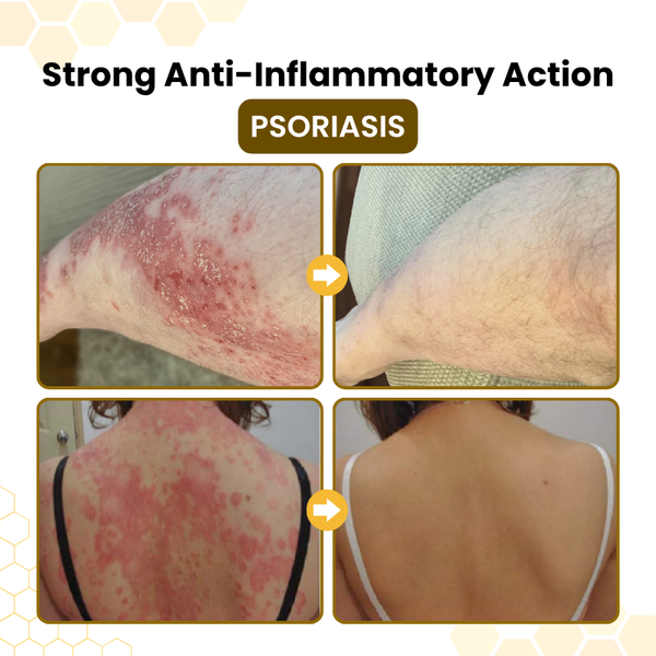PsoriaSoothe Bee Rescue Cream