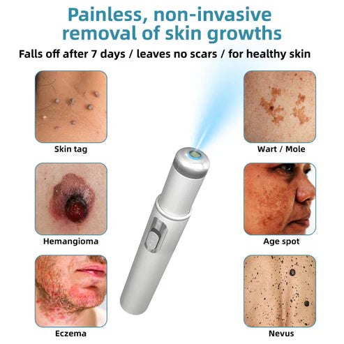 Mole and Wart Removal Laser Pen - Laser Technology