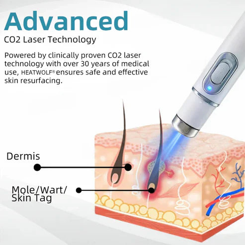Mole and Wart Removal Laser Pen - Laser Technology