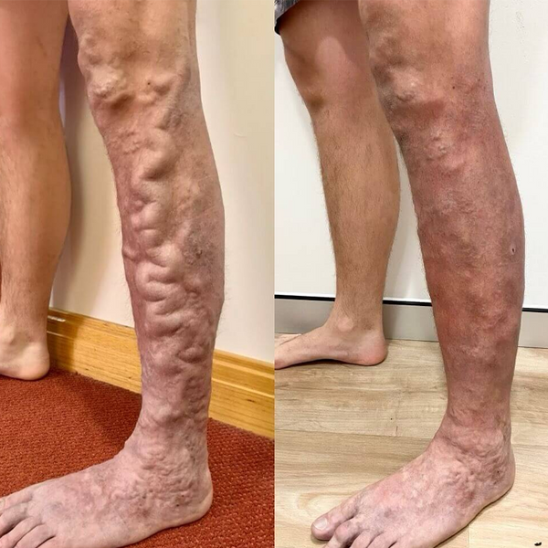 VeinGuard Herbal Spray