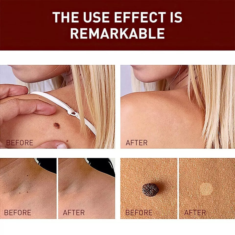 Kin Tag Liquid Nitro Skin Tags Moles Wart Remover Liquid Pen – Maison Luvine