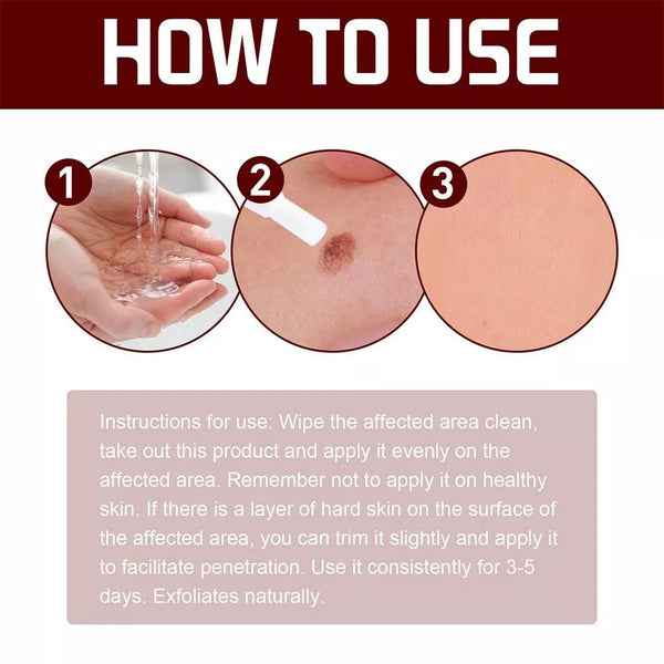 Skin Tags Moles Wart Remover Liquid Pen