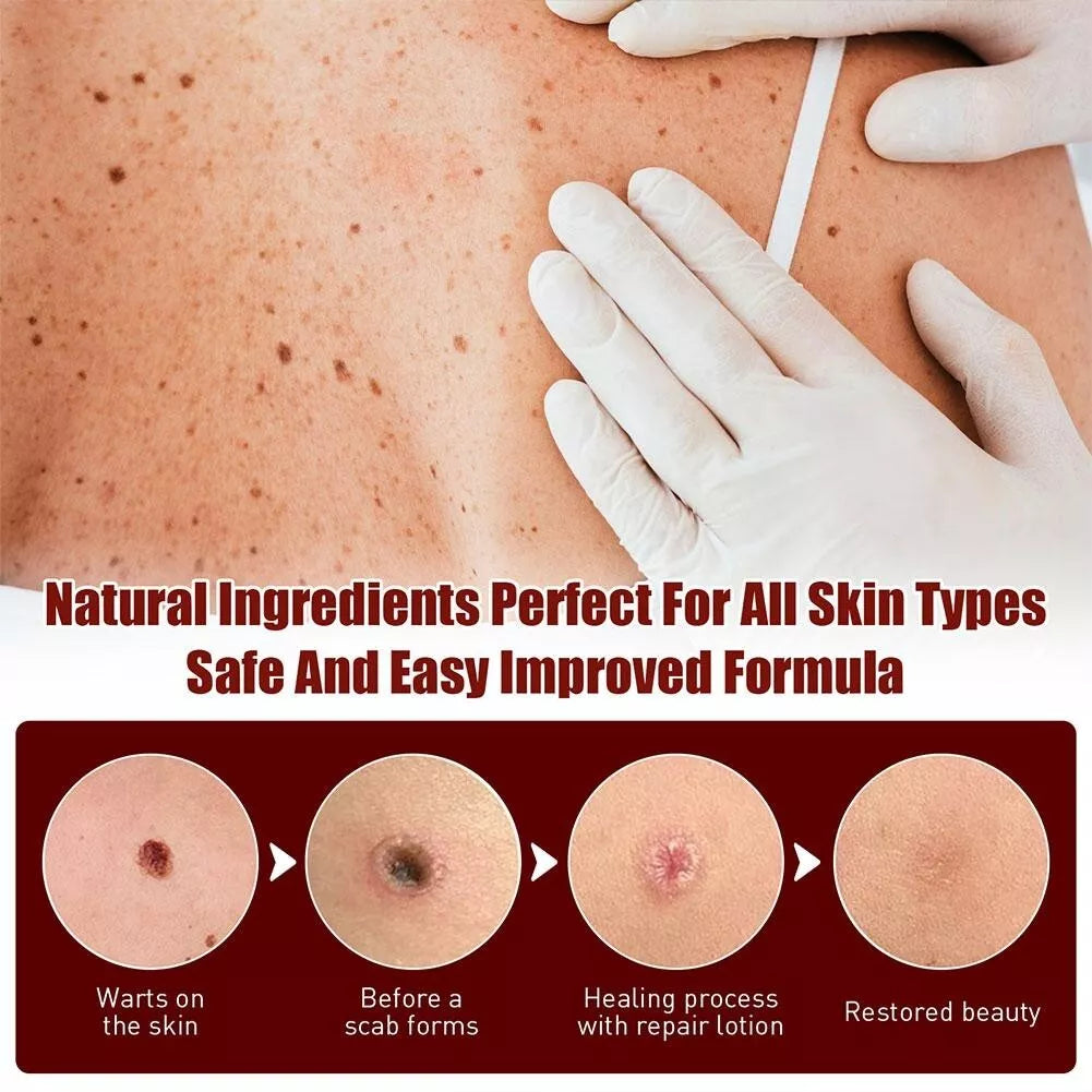 Skin Tags Moles Wart Remover Liquid Pen